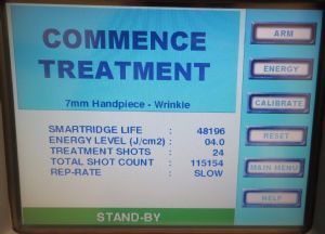 Chromogenex NLite V Pulsed Dye 585nm Medical Laser Acne Wrinkle Vascular System 2.jpg